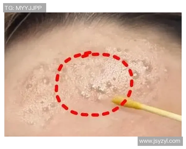 挤痘痘后肺部竟被啃出十多个空洞的惊人案例解析